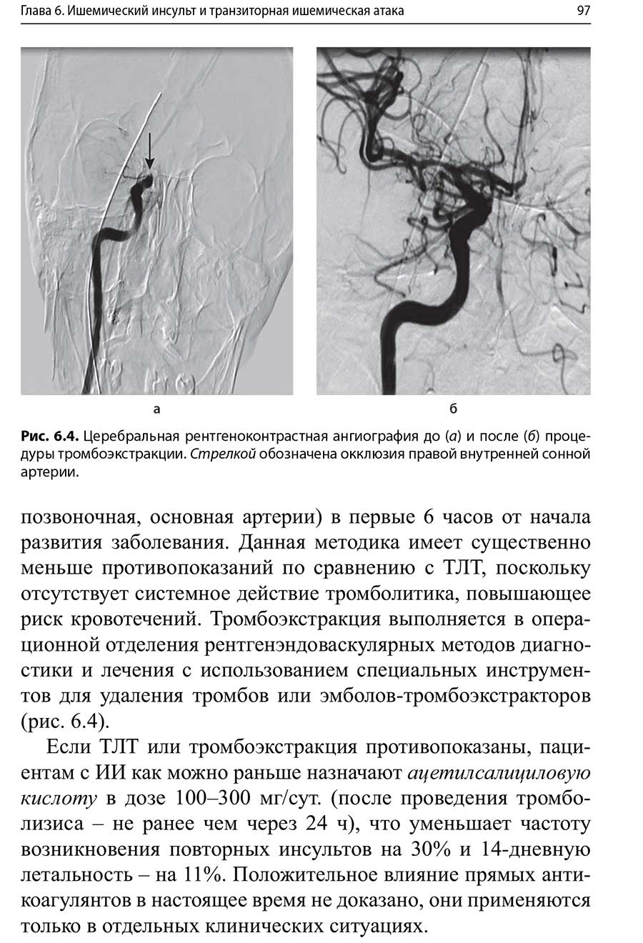 Церебральная рентгеноконтрастная ангиография