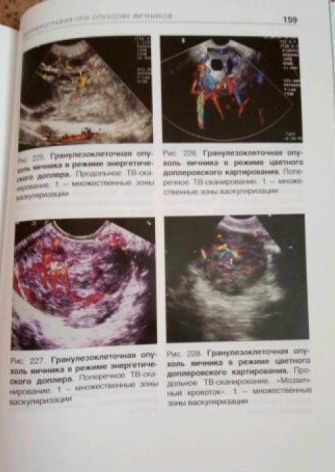 Пример страницы из книги "Эхография органов малого таза у женщин. Пограничные опухоли, рак и редкие опухоли яичников" - Демидов В. Н.