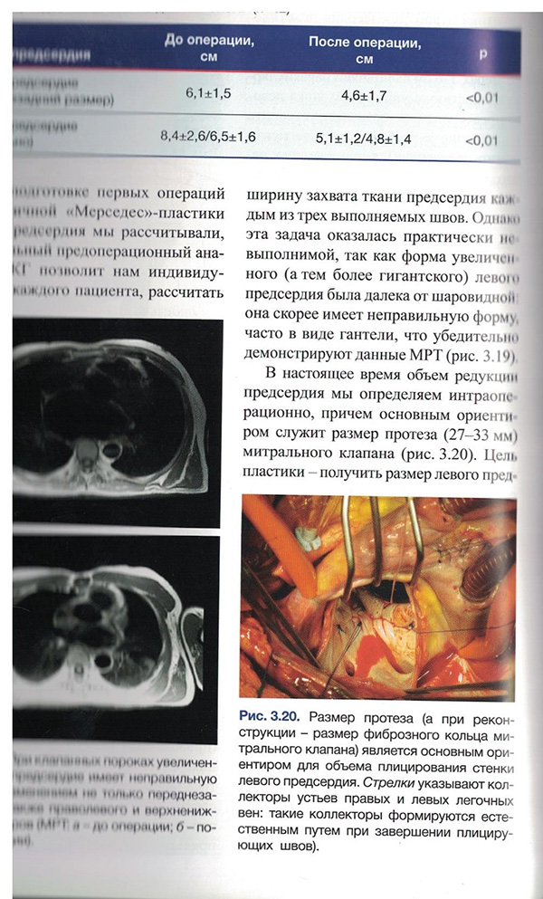 Рис. 3.20. Размер протеза (а при реконструкции - размер фиброзного кольца митрального клапана(