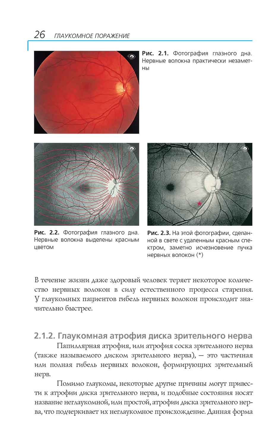 Рис. 2.2. Фотография глазного дна. Нервные волокна выделены красным цветом