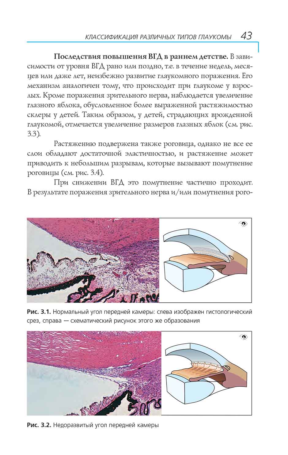 Рис. 3.2. Недоразвитый угол передней камеры