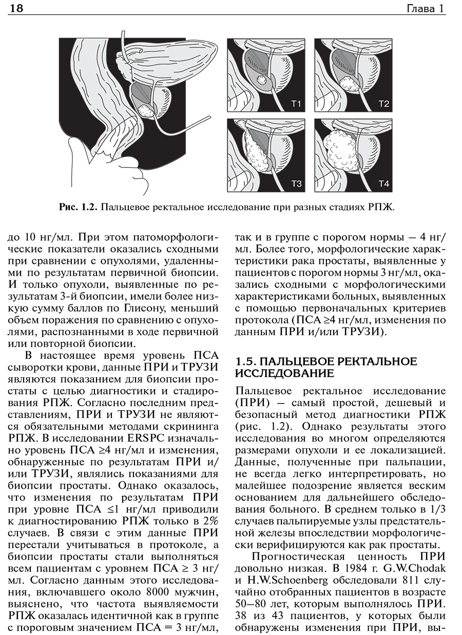 Пальцевое ректальное исследование при разных стадиях РПЖ.