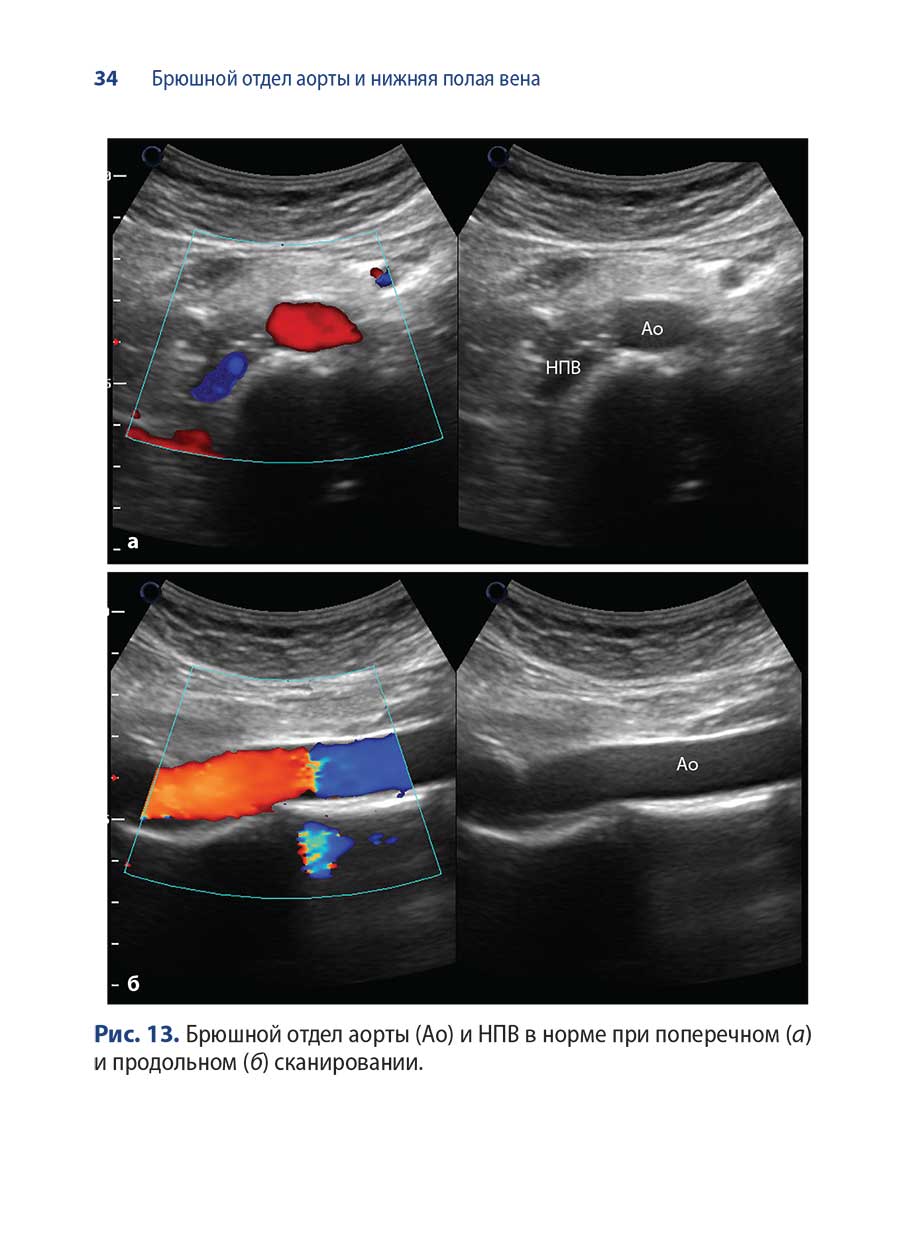 Рис. 13. Брюшной отдел аорты (Ао) и НПВ в норме при поперечном (а) и продольном (6) сканировании.