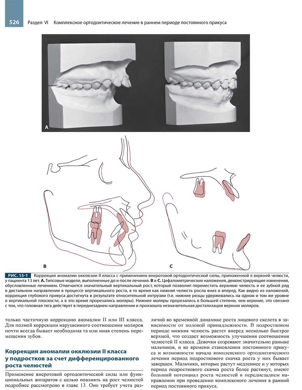 Коррекция аномалии окклюзии II класса с применением внеротовой ортодонтической силы.
