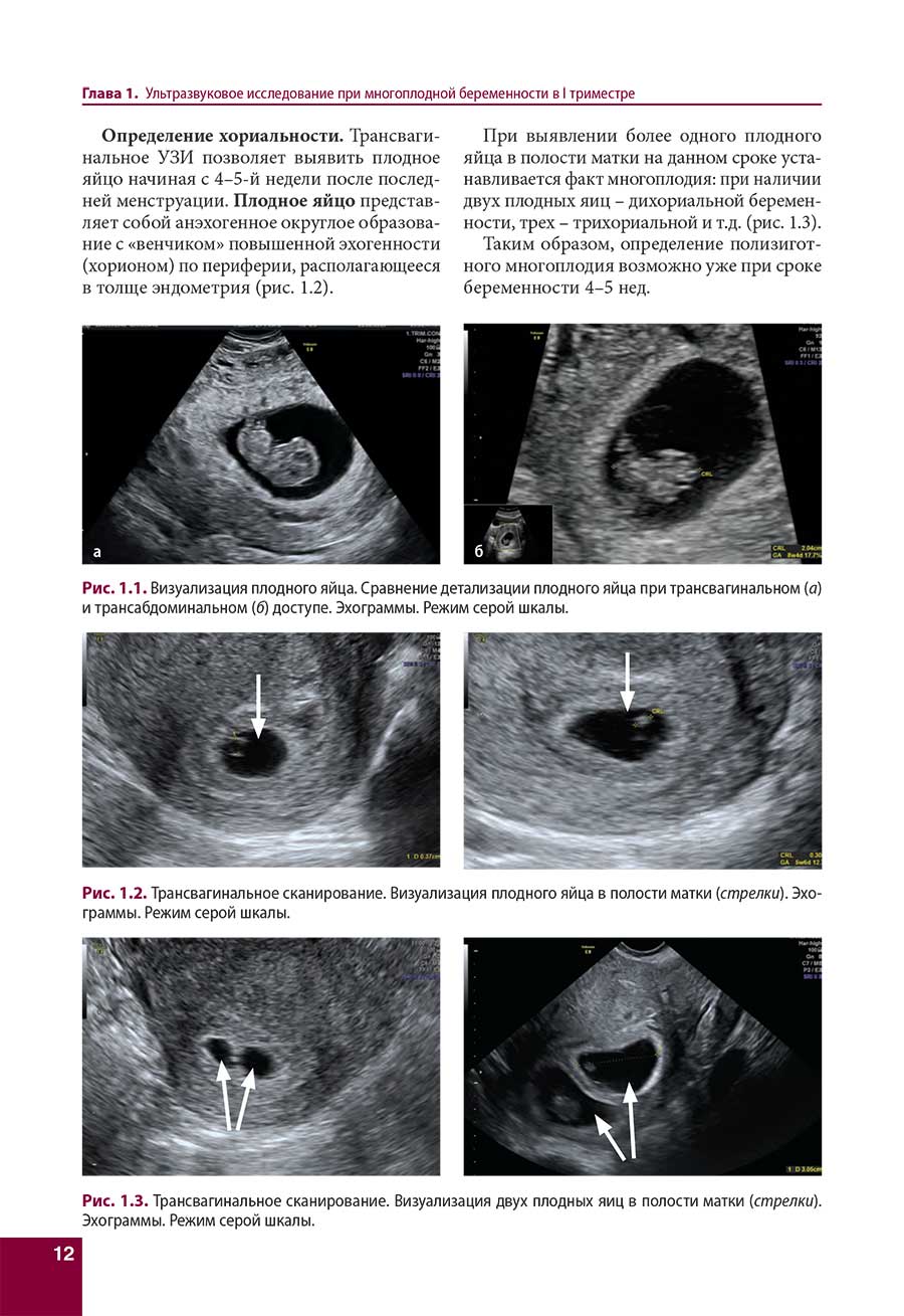 Рис. 1.3. Трансвагинальное сканирование. Визуализация двух плодных яиц в полости матки (стрелки).
