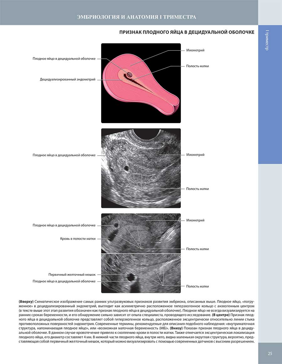 Схематическое изображение самых ранних ультразвуковых признаков развития эмбриона, описанных выше.