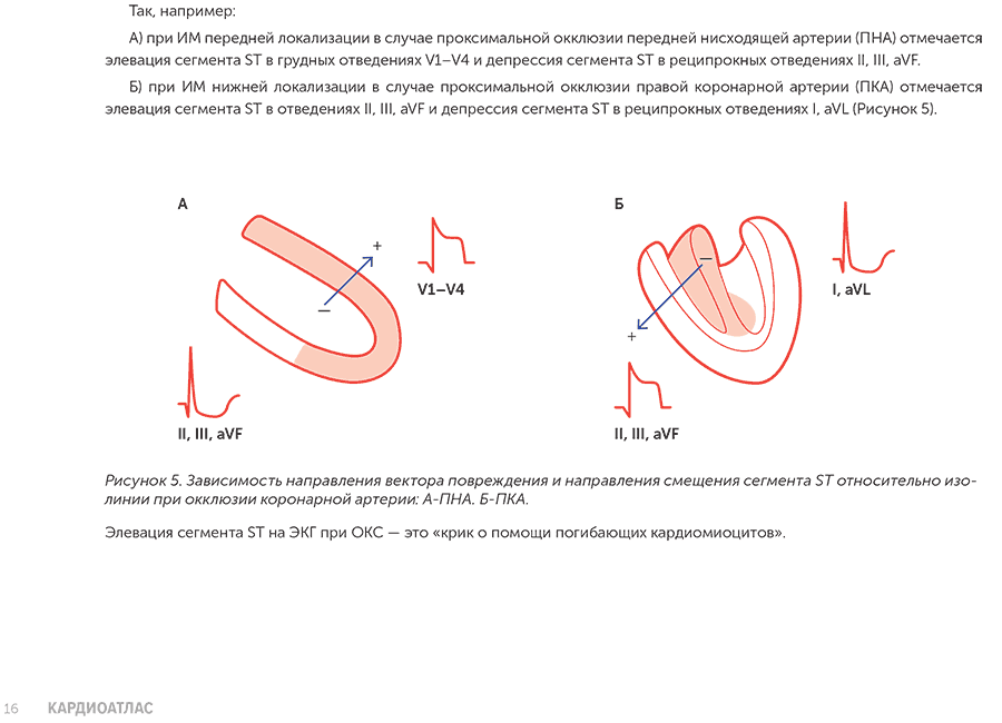 Рисунок 5. Зависимость направления вектора повреждения и направления смещения сегмента ST
