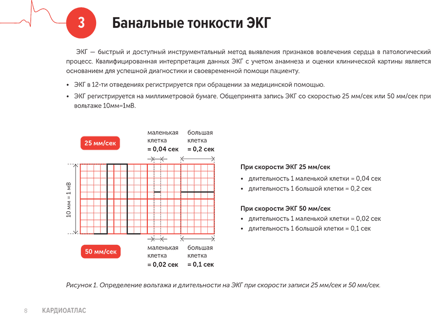 Рисунок 1. Определение вольтажа и длительности на ЭКГ при скорости записи 25 мм/сек и 50 мм/сек.