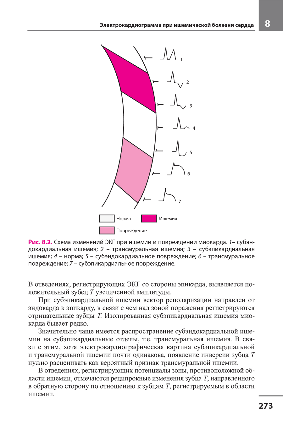 Рис. 8.2. Схема изменений ЭКГ при ишемии и повреждении миокарда.