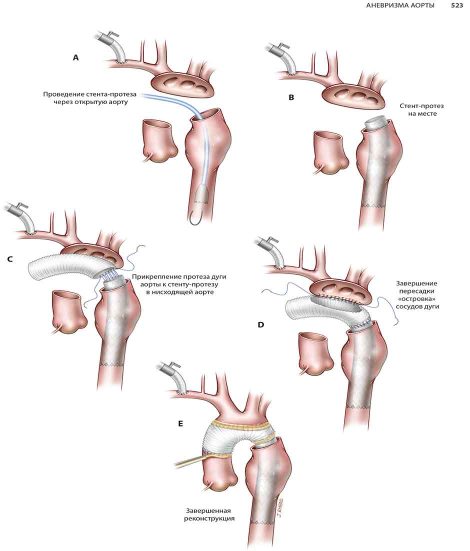 Пример страницы из книги "Кардиохирургия. Техника выполнения операций"