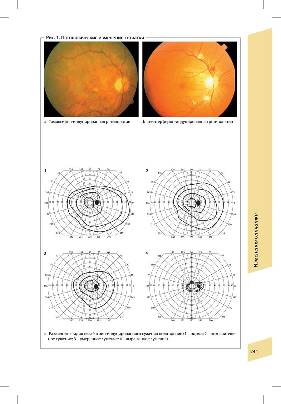 с Различные стадии вигабатрин-индуцированного сужения поля зрения
