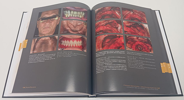 Примеры страниц из книги "Скуловая имплантация. Практическое руководство" - Чезаре Паолески