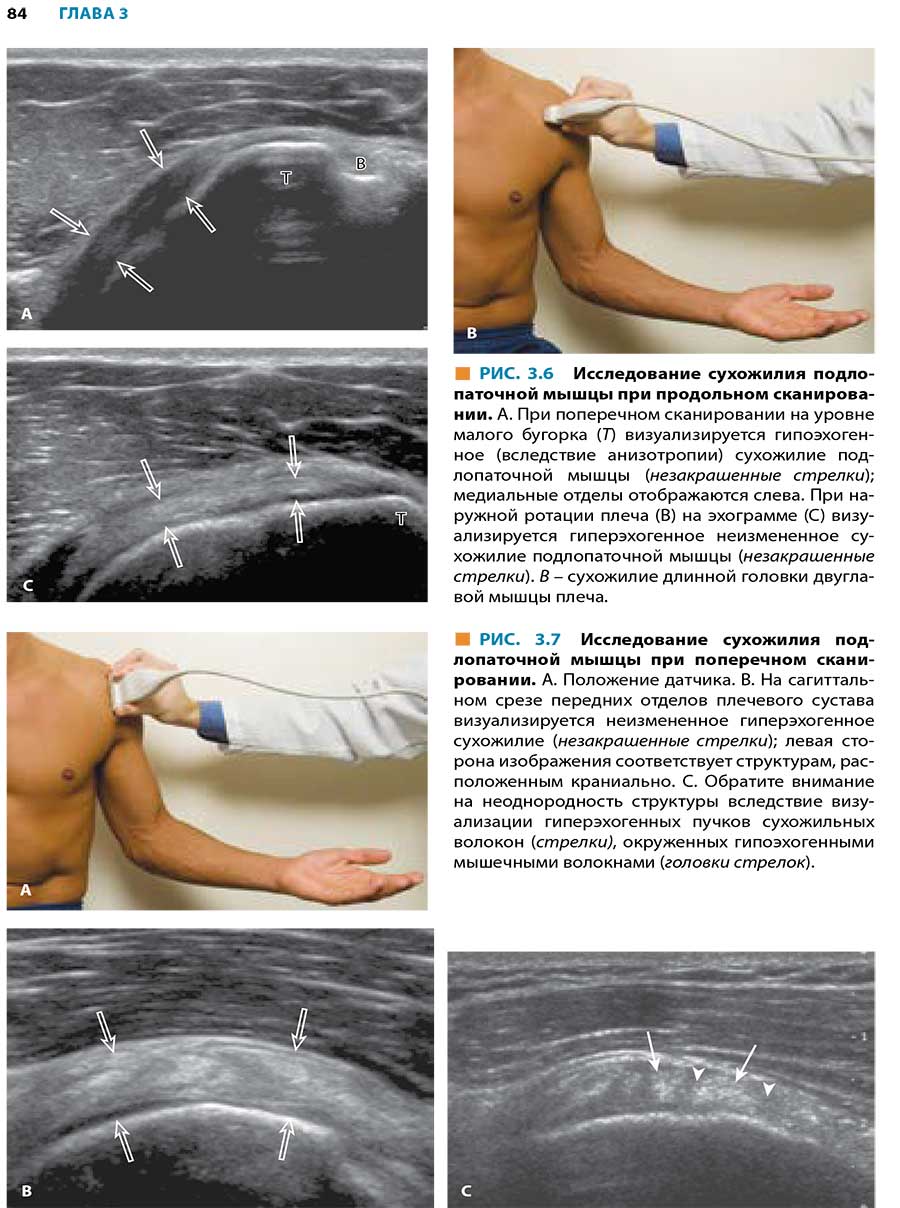 Исследование сухожилия подлопаточной мышцы при продольном сканировании