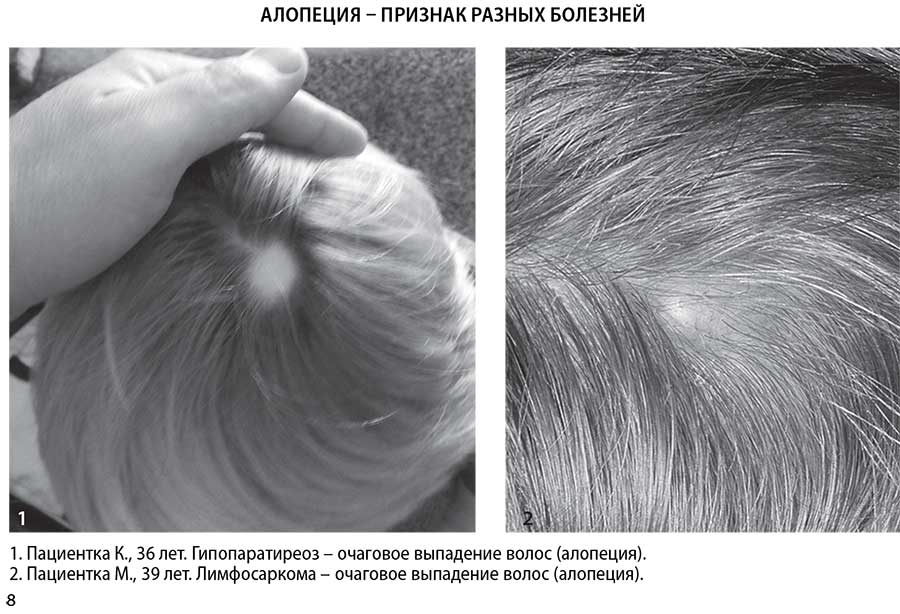 Гипопаратиреоз - очаговое выпадение волос (алопеция)