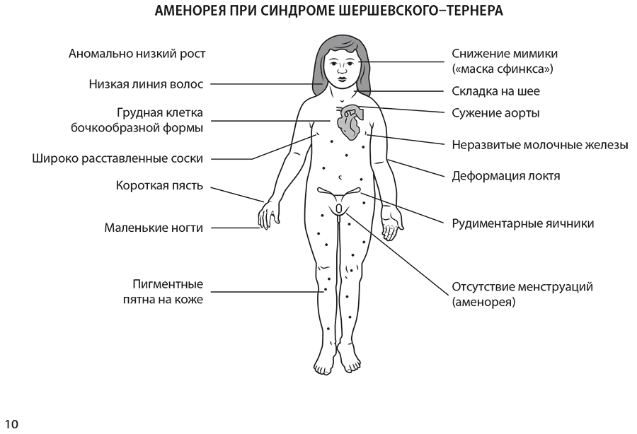 Аменорея при синдроме Шерешевского-Тернера