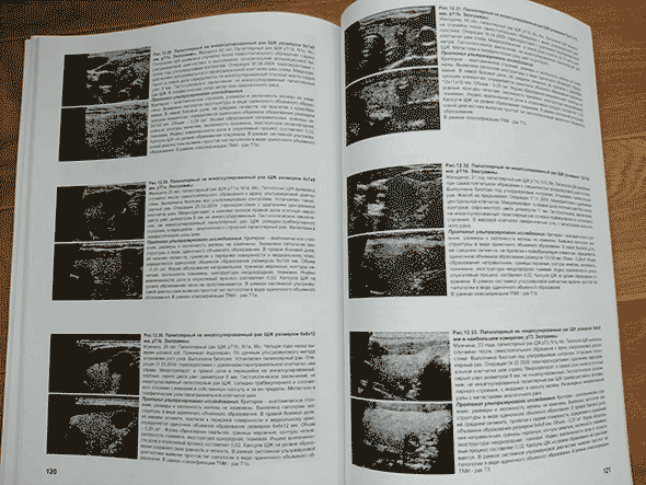 Пример страницы из книги "Ультразвуковая диагностика заболеваний щитовидной железы и эффективность ультразвукового скрининга в раннем выявлении рака и других заболеваний" - В. С. Паршин Пример страницы из книги "Ультразвуковая диагностика заболеваний щитовидной железы и эффективность ультразвукового скрининга в раннем выявлении рака и других заболеваний" - В. С. Паршин