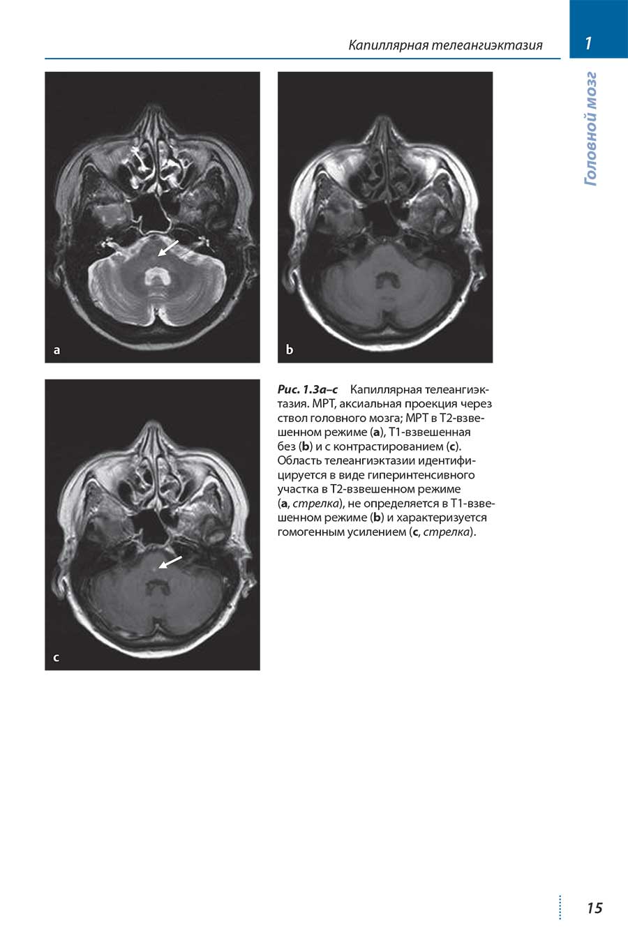Рис. 1.3а-с Капиллярная телеангиэктазия. MPT, аксиальная проекция через ствол головного мозга; МРТ в Т2-взвешенном режиме (а), Т1-взвешенная