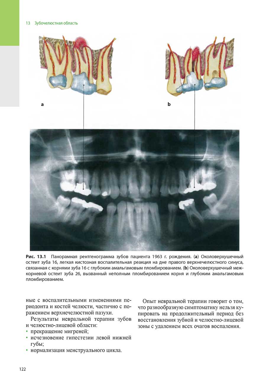 Рис. 13.1 Панорамная рентгенограмма зубов пациента 1963 г. рождения.