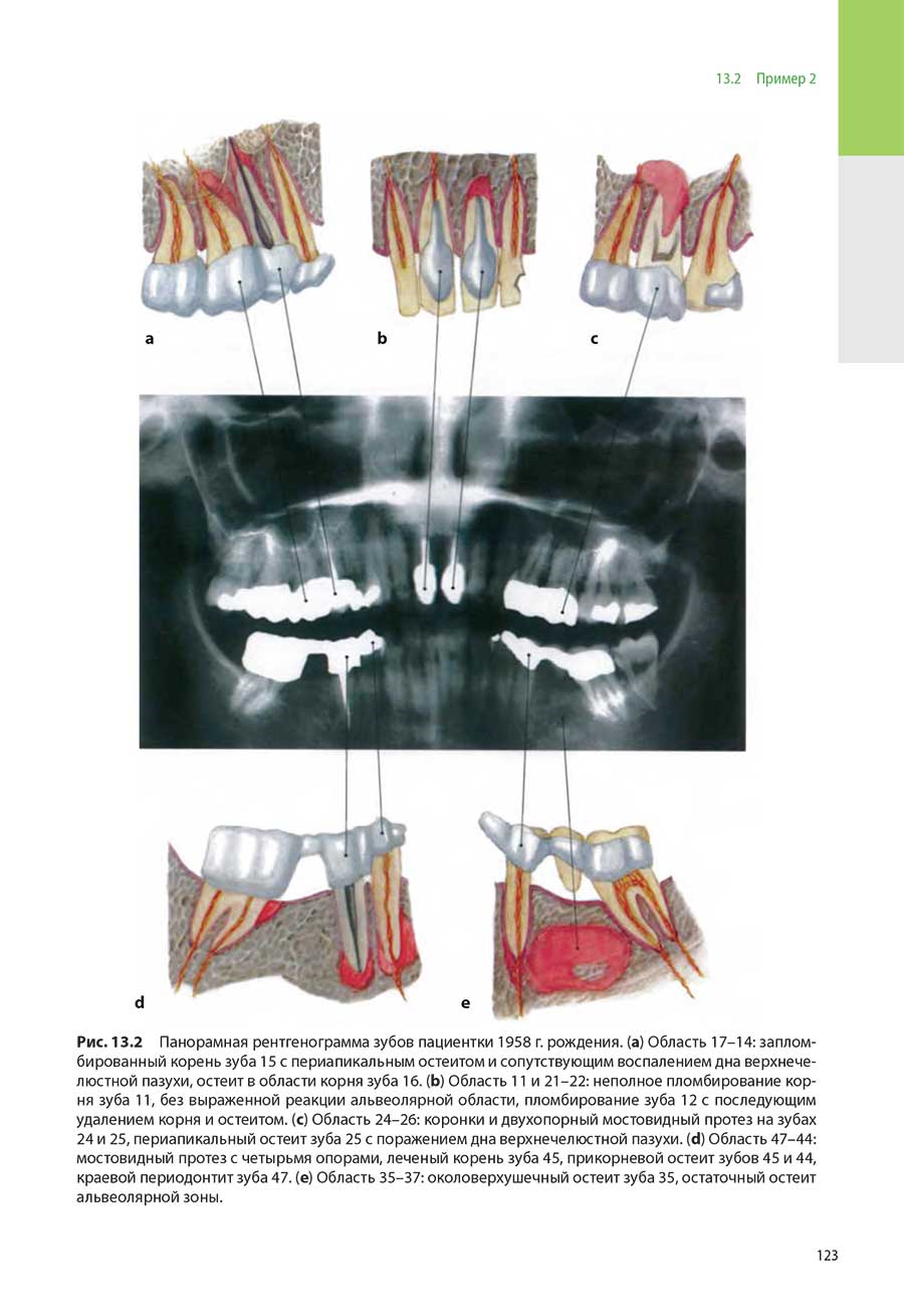 Рис. 13.2 Панорамная рентгенограмма зубов пациентки