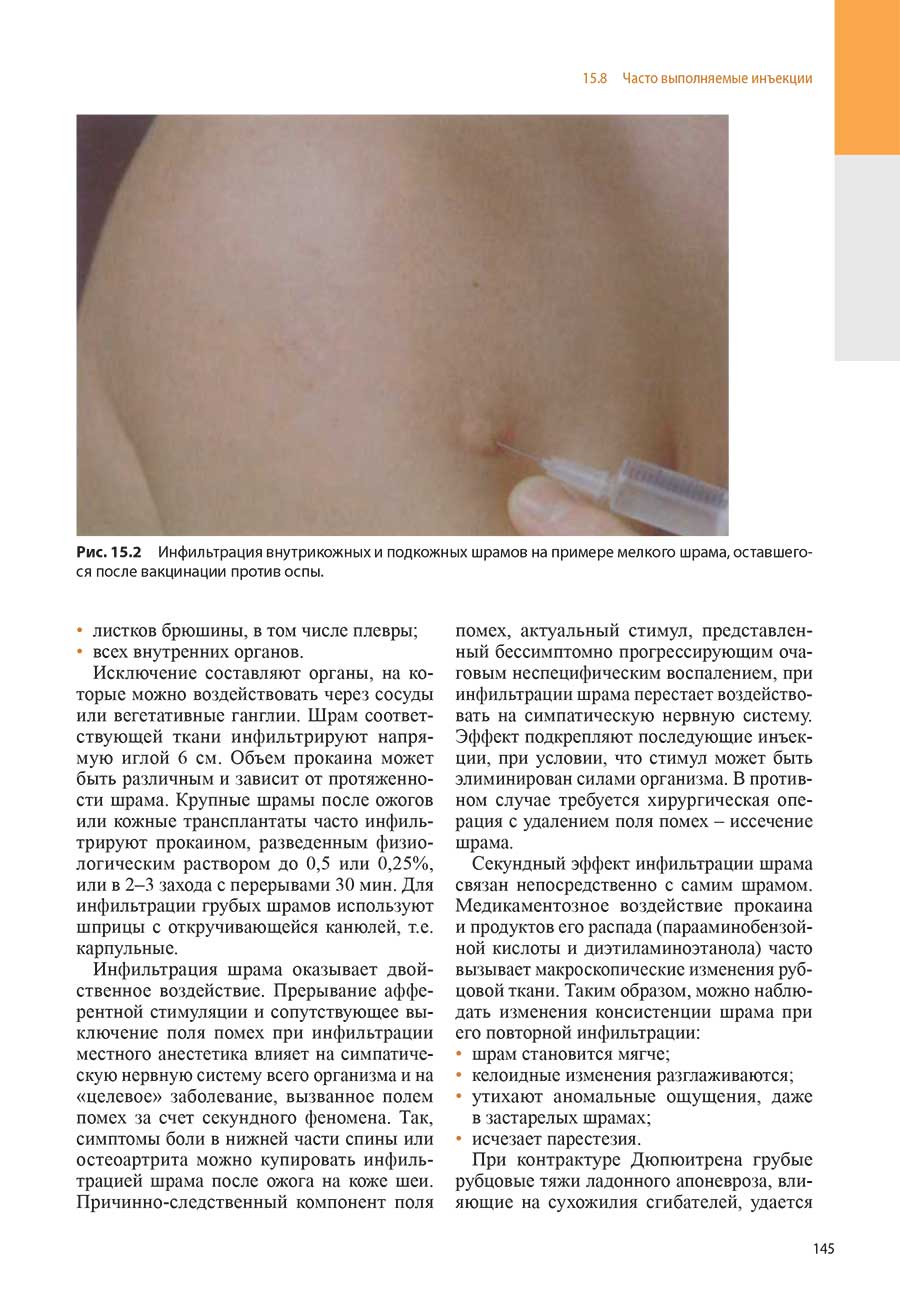 Рис. 15.2 Инфильтрация внутрикожных и подкожных шрамов на примере мелкого шрама