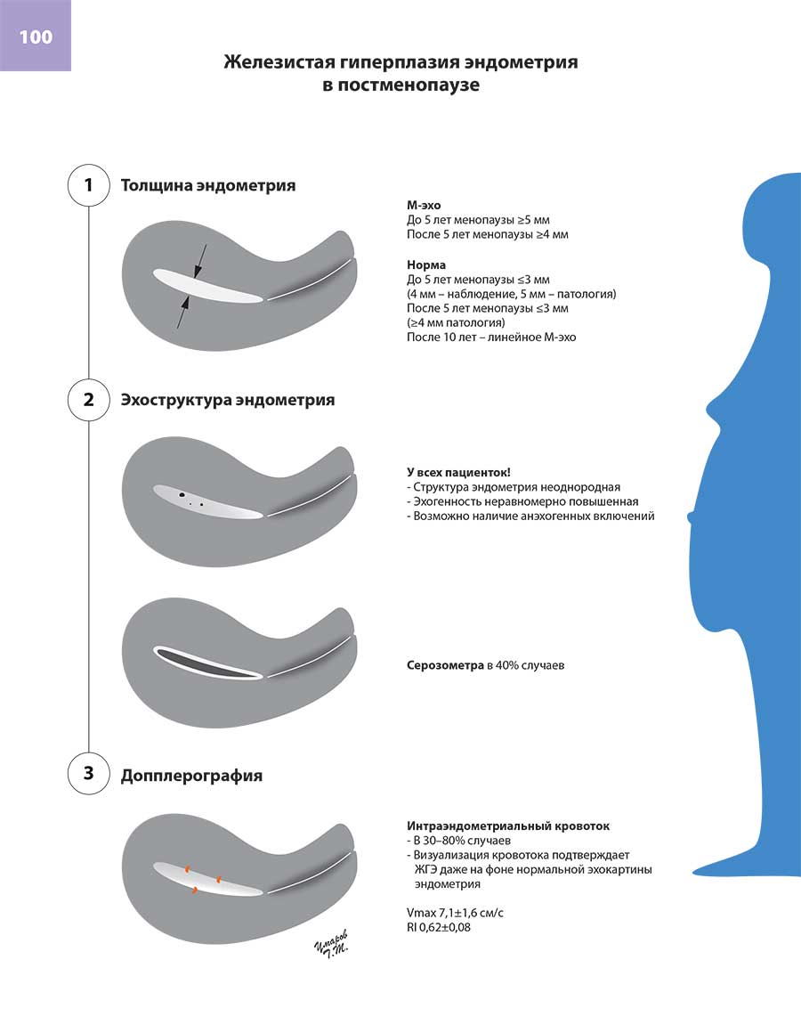Железистая гиперплазия эндометрия в постменопаузе