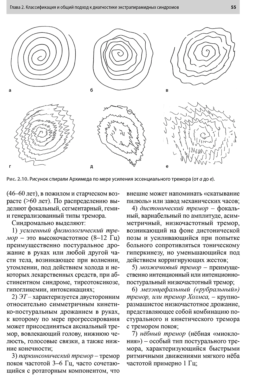 Рис. 2.10. Рисунок спирали Архимеда по мере усиления эссенциального тремора