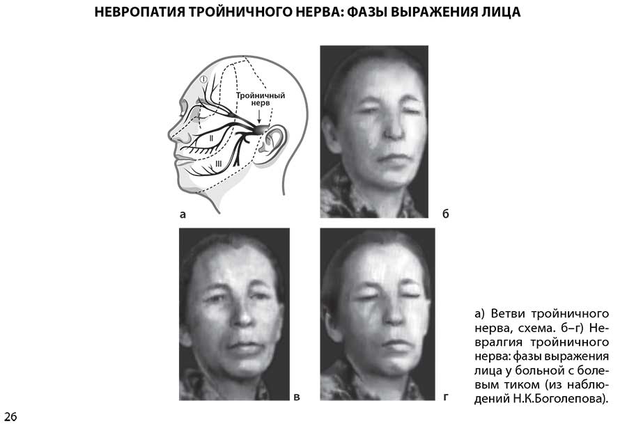 Невропатия тройничного нерва: фазы выражения лица
