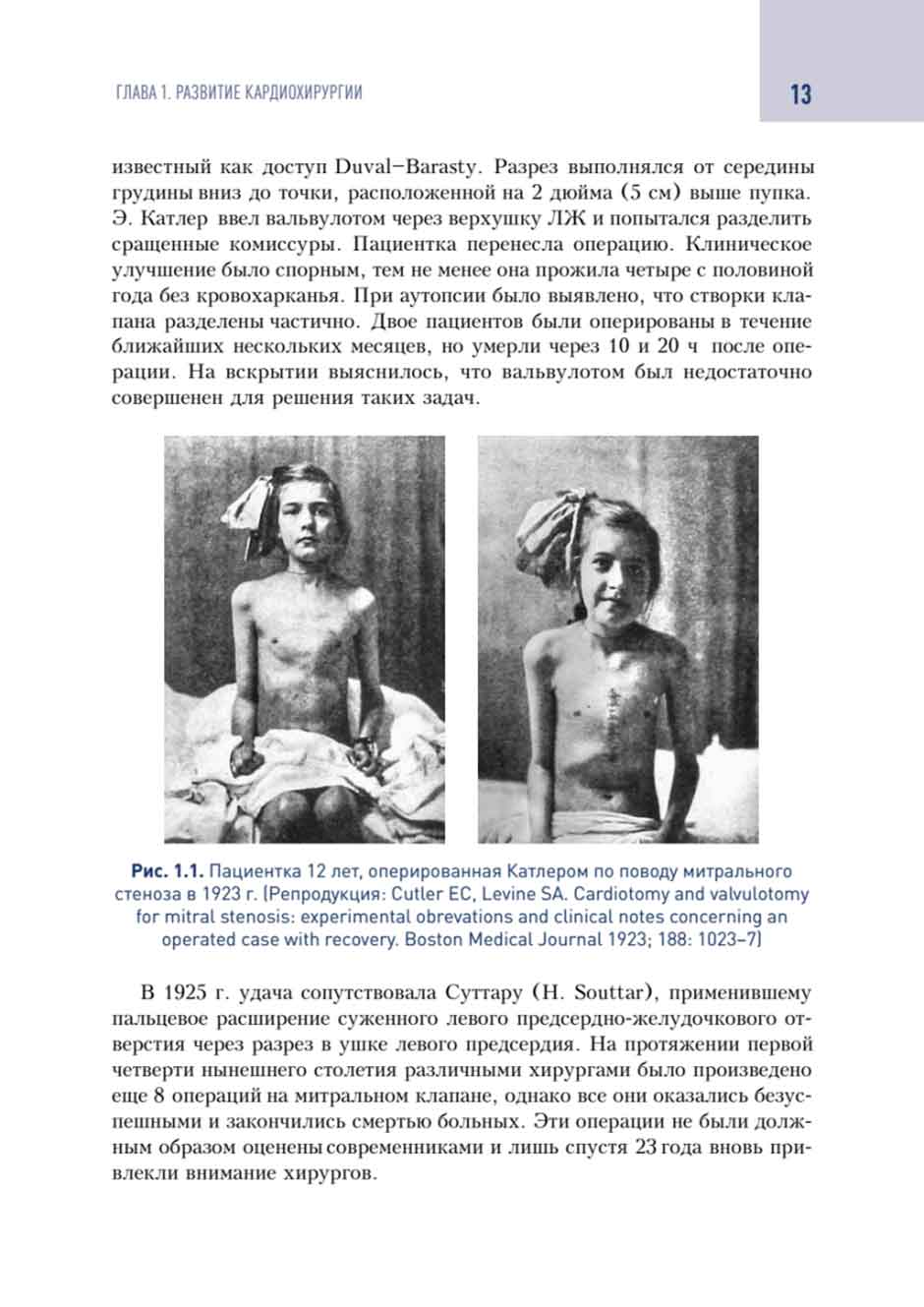 Рис. 1.1. Пациентка 12 лет. оперированная Катлером по поводу митрального стеноза в 1923 г. 