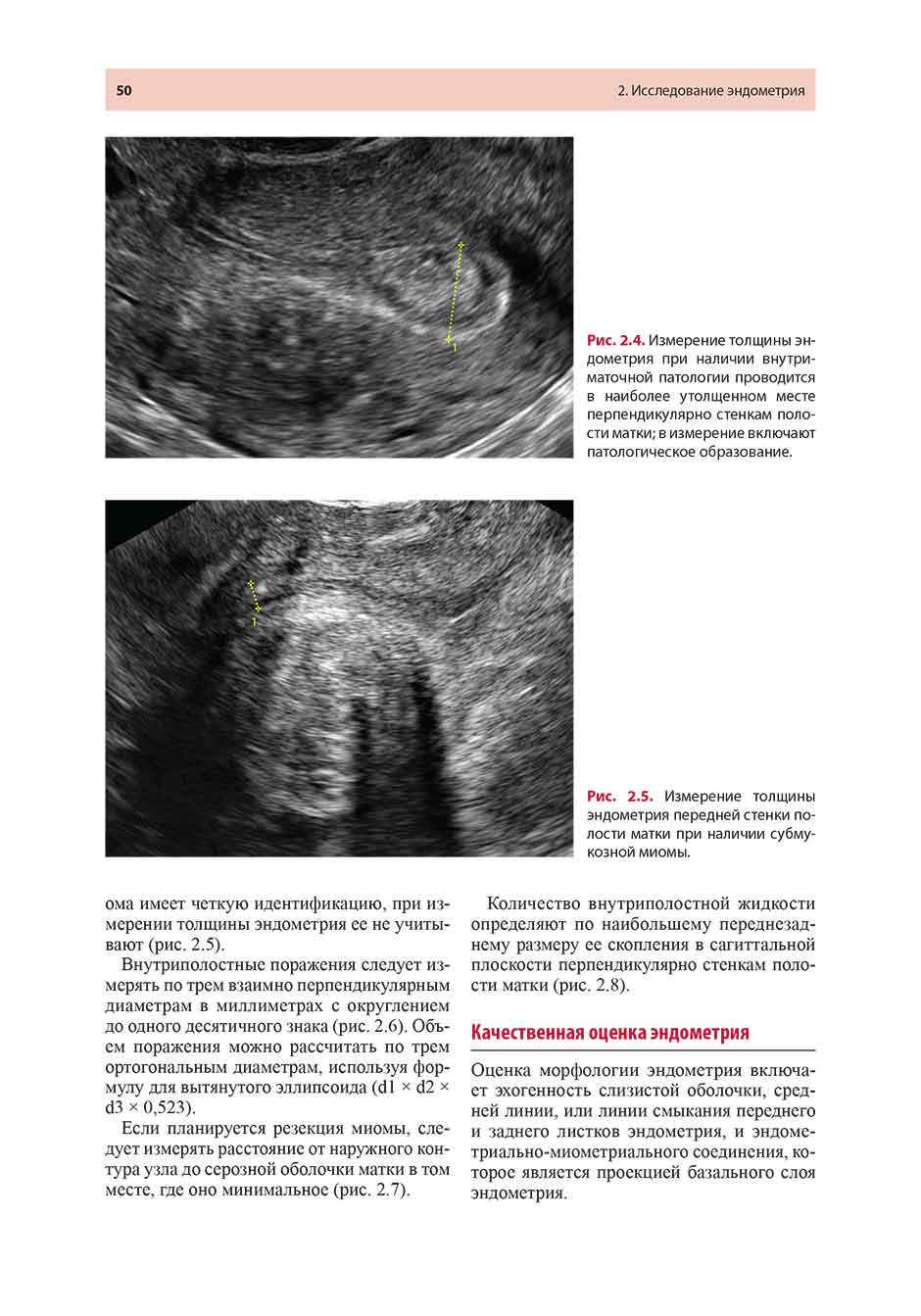 Рис. 2.5. Измерение толщины эндометрия передней стенки полости матки при наличии субмукозной миомы.