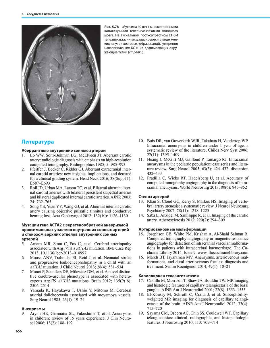 Рис. 5.78 Мужчина 40 лет с множественными капиллярными телеангиэктазиями головного мозга. На аксиальном постконтрастном Т1-ВИ