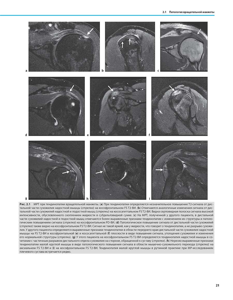 MPT при тендинопатии вращательной манжеты