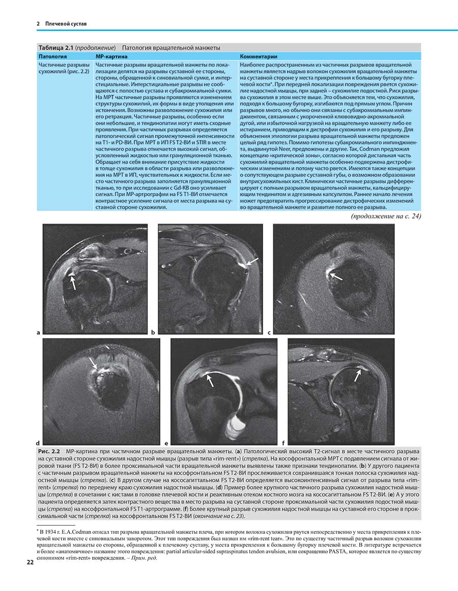 MP-картина при частичном разрыве вращательной манжеты