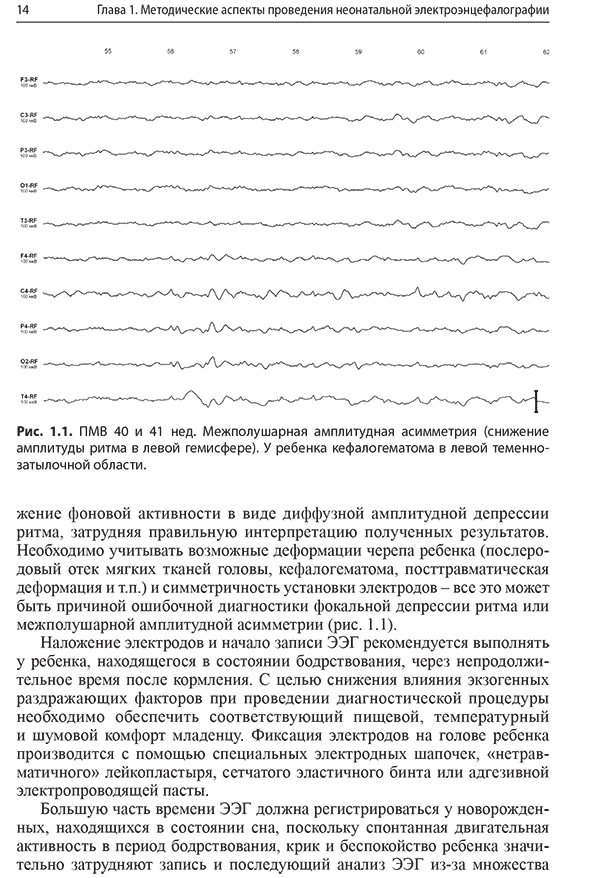 Межполушарная амплитудная асимметрия