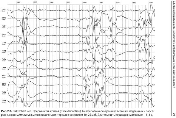 1. Скорость развертки – 15 мм/с. ПМВ 26/27 нед. Tracé discontinu. Билатеральная вспышка активности с включением высокоамплитудных медленных и заостренных волн