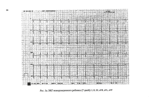 ЭКГ новорожденного ребенка 