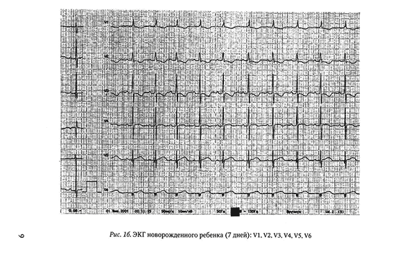 ЭКГ новорожденного ребенка