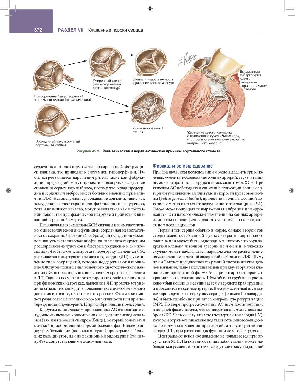 Ревматическая и неревматическая причины аортального стеноза.