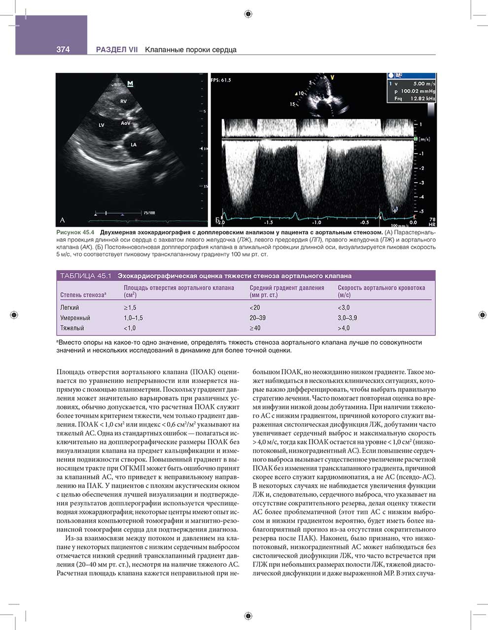 Двухмерная эхокардиография с допплеровским анализом у пациента с аортальным стенозом.