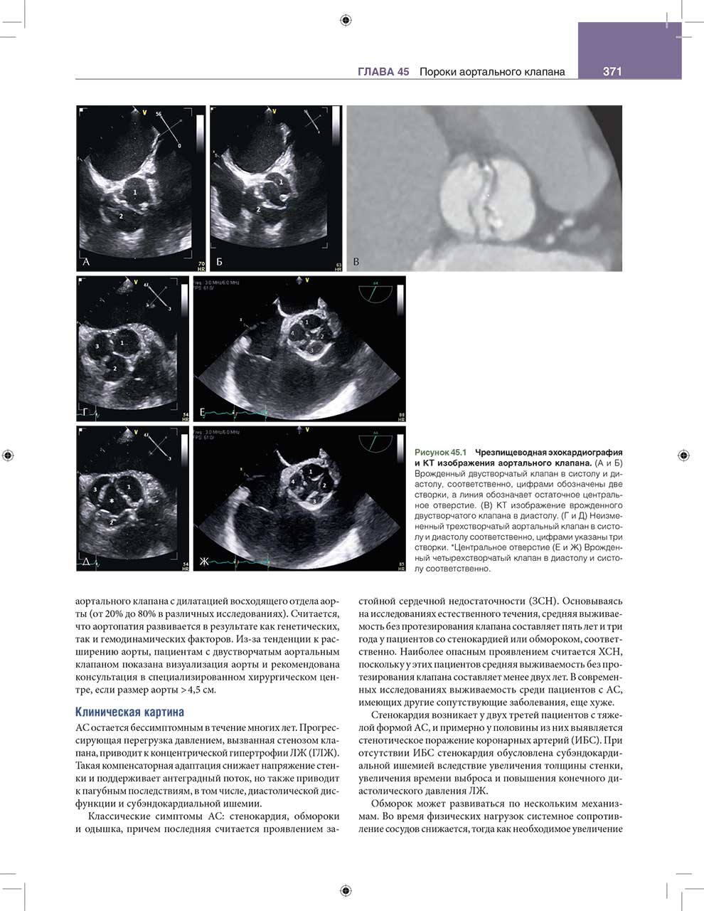 Рисунок 45.1 Чрезпищеводная эхокардиография и КТ изображения аортального клапана. (А и 6)