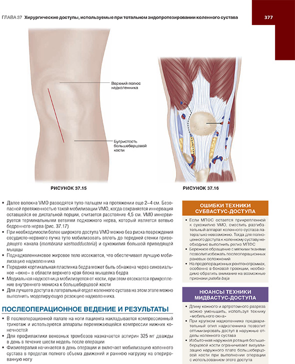 Хирургические доступы, используемые при тотальном эндопротезировании коленного сустава