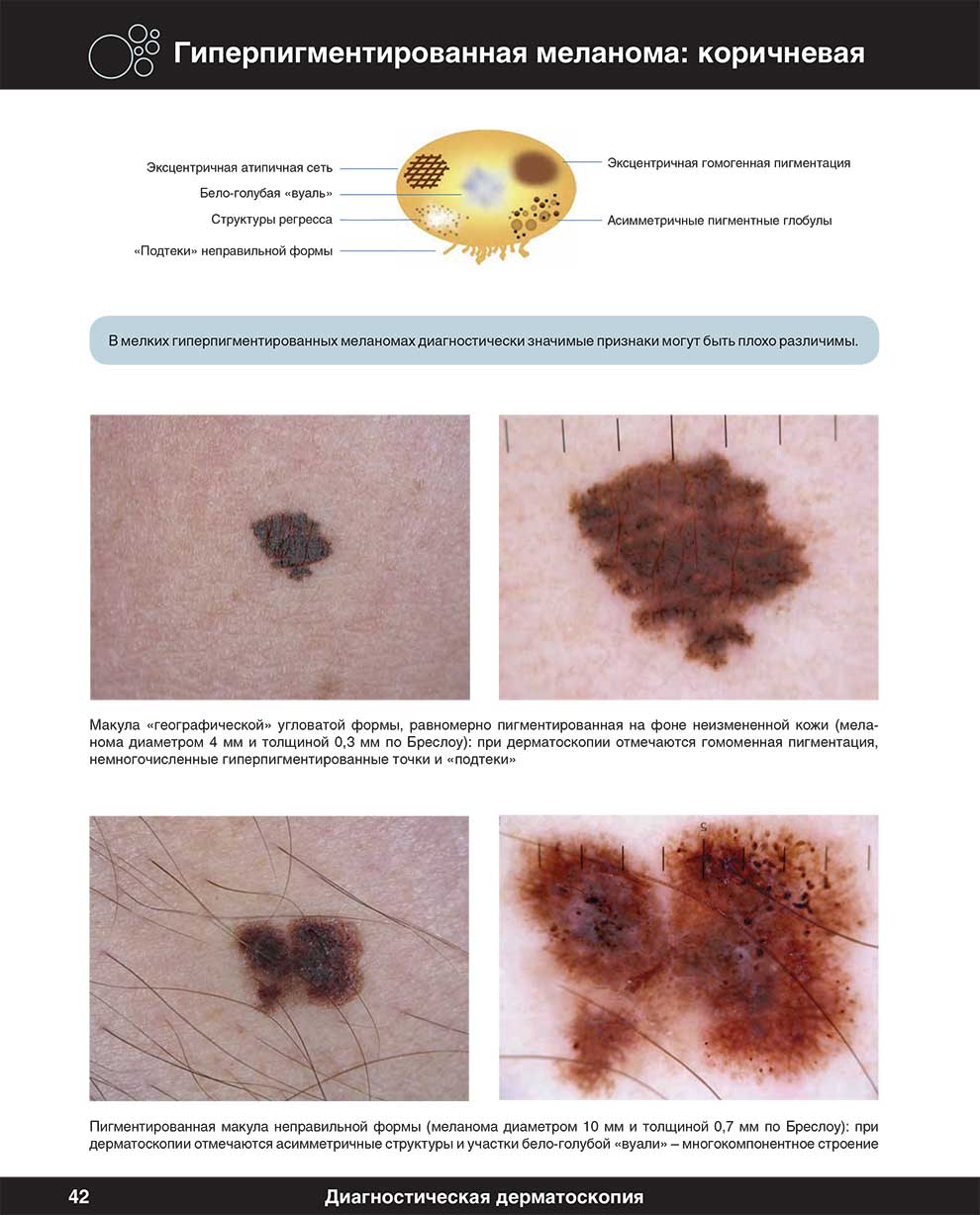 Гиперпигментированная меланома: коричневая