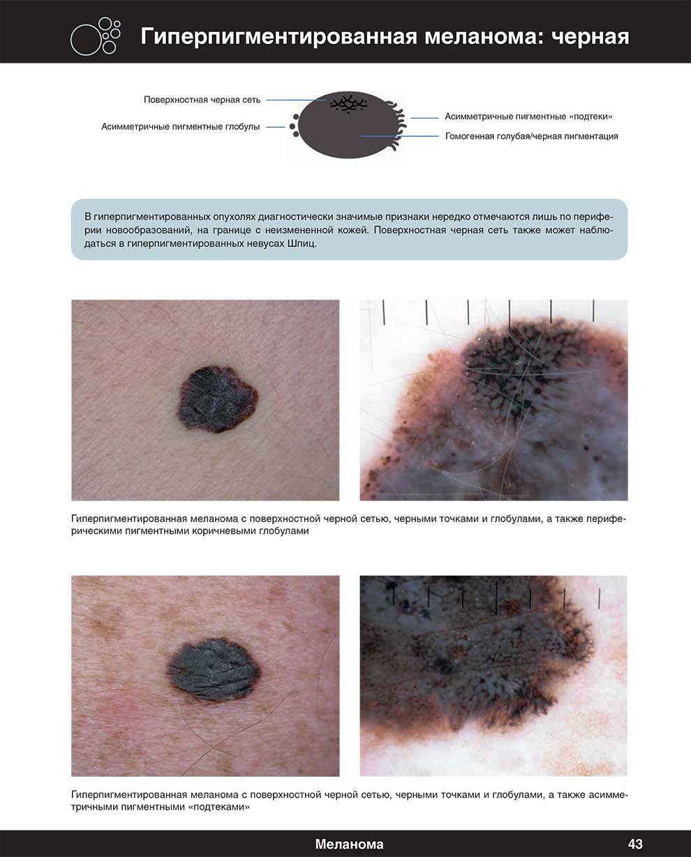 Гиперпигментированная меланома: черная