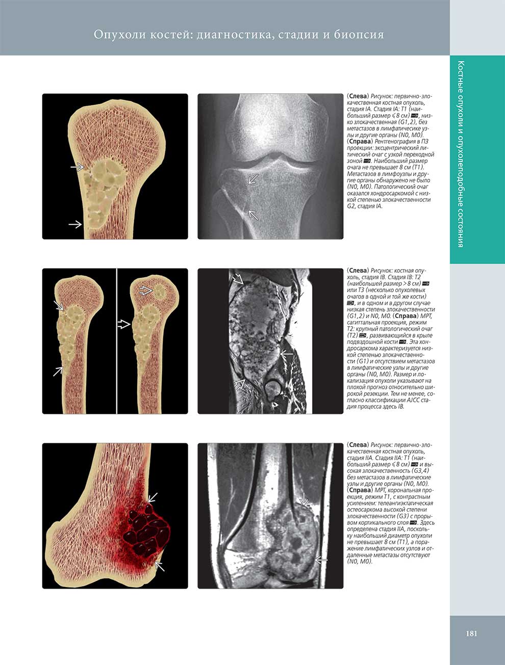 Опухоли костей: диагностика, стадии и биопсия