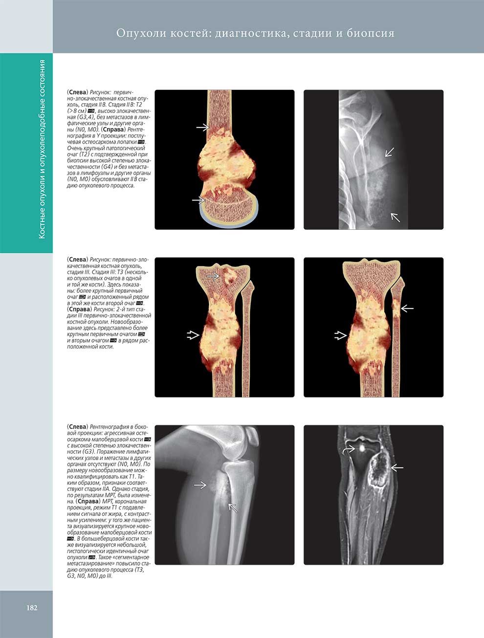 Опухоли костей: диагностика, стадии и биопси