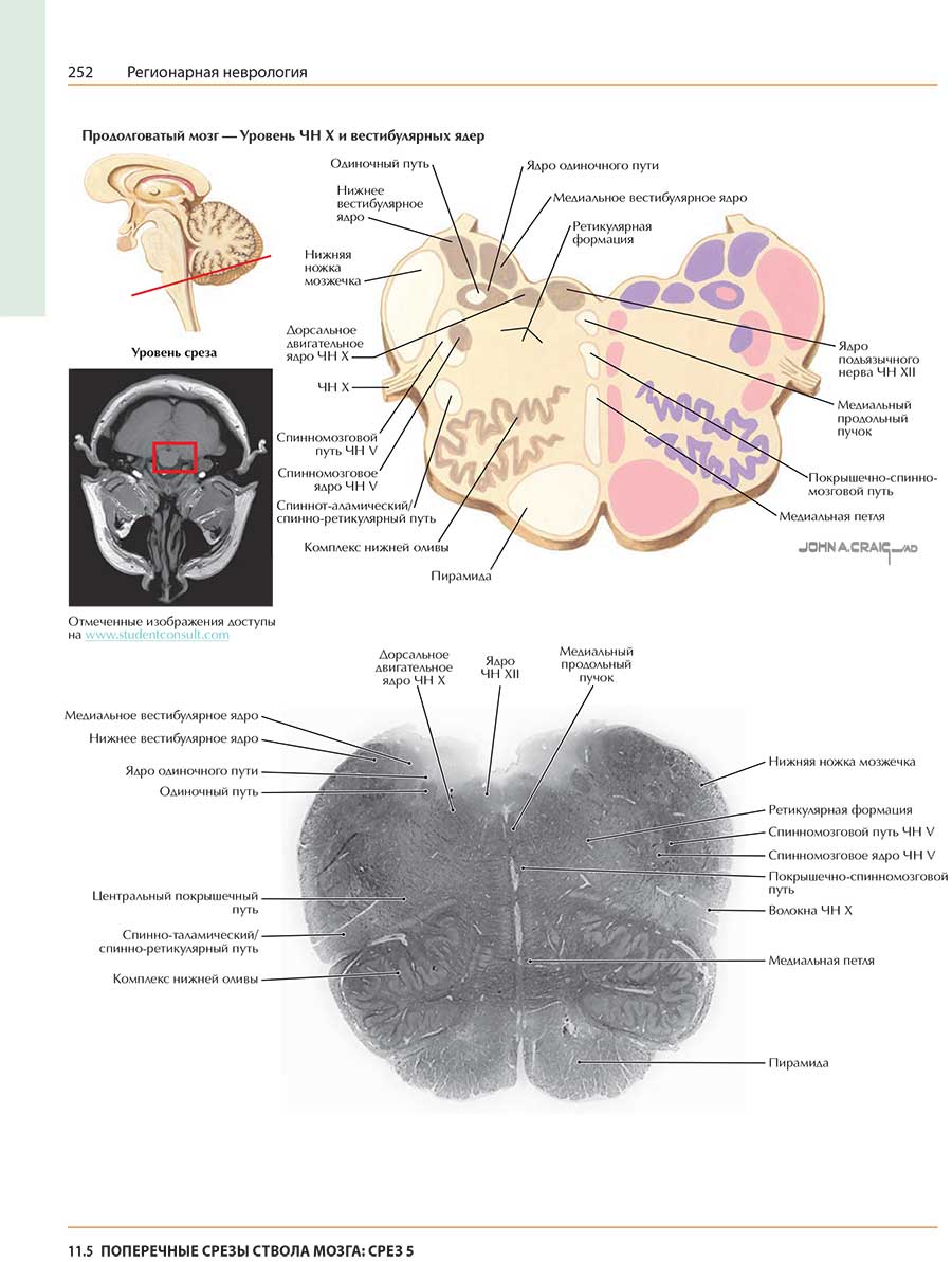 Продолговатый мозг — Уровень ЧН X и вестибулярных ядер