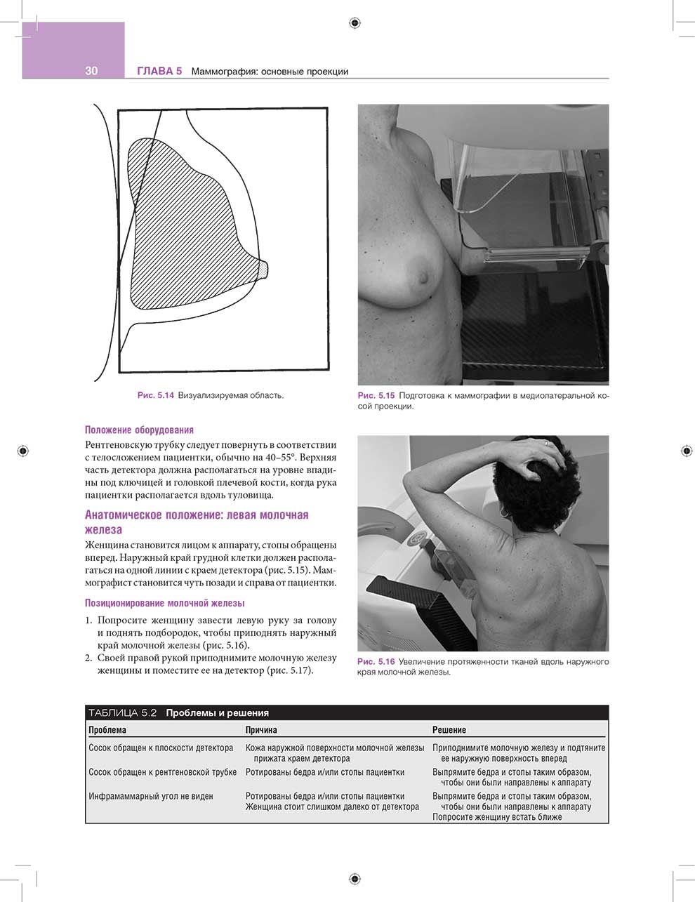 Рис. 5.16 Увеличение протяженности тканей вдоль наружного края молочной железы.
