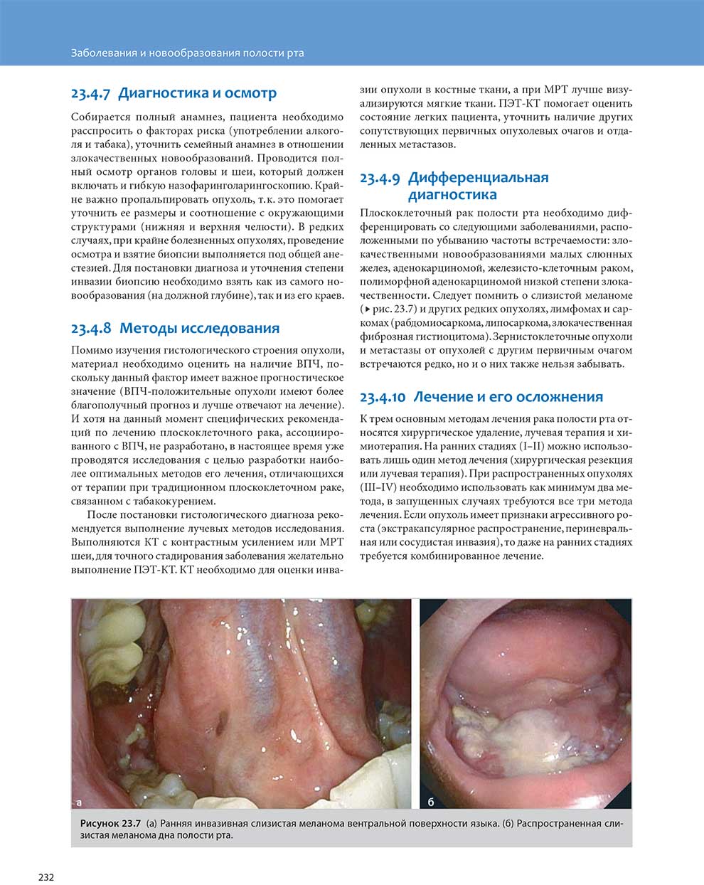 Ранняя инвазивная слизистая меланома вентральной поверхности языка.