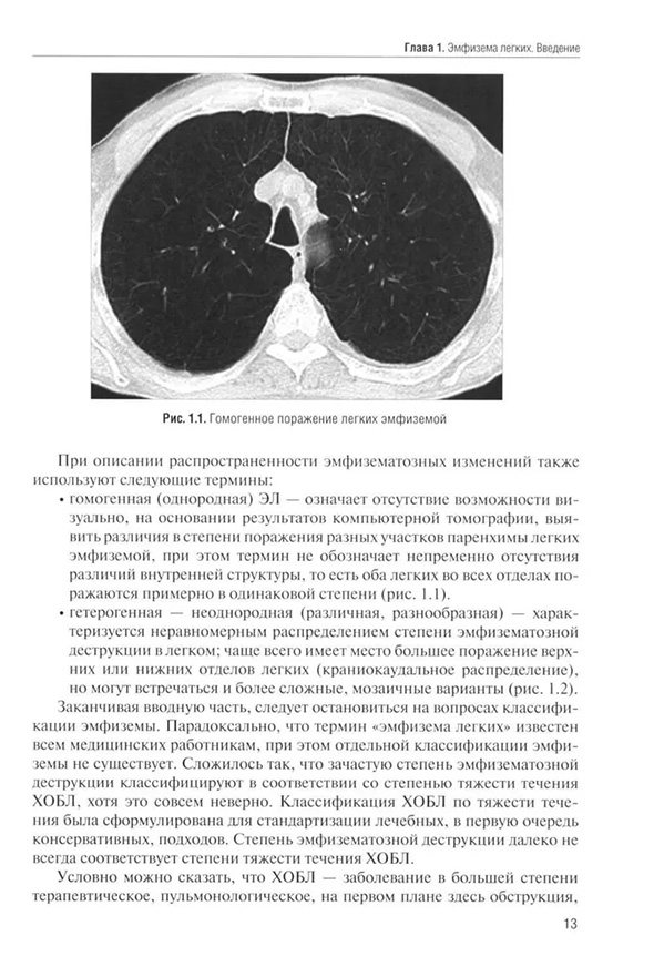 Гомогенное поражение легких эмфиземой