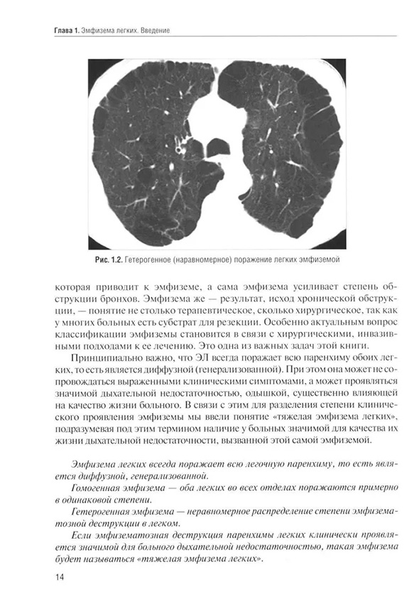 Гетерогенное (наравномерное) поражение легких эмфиземой