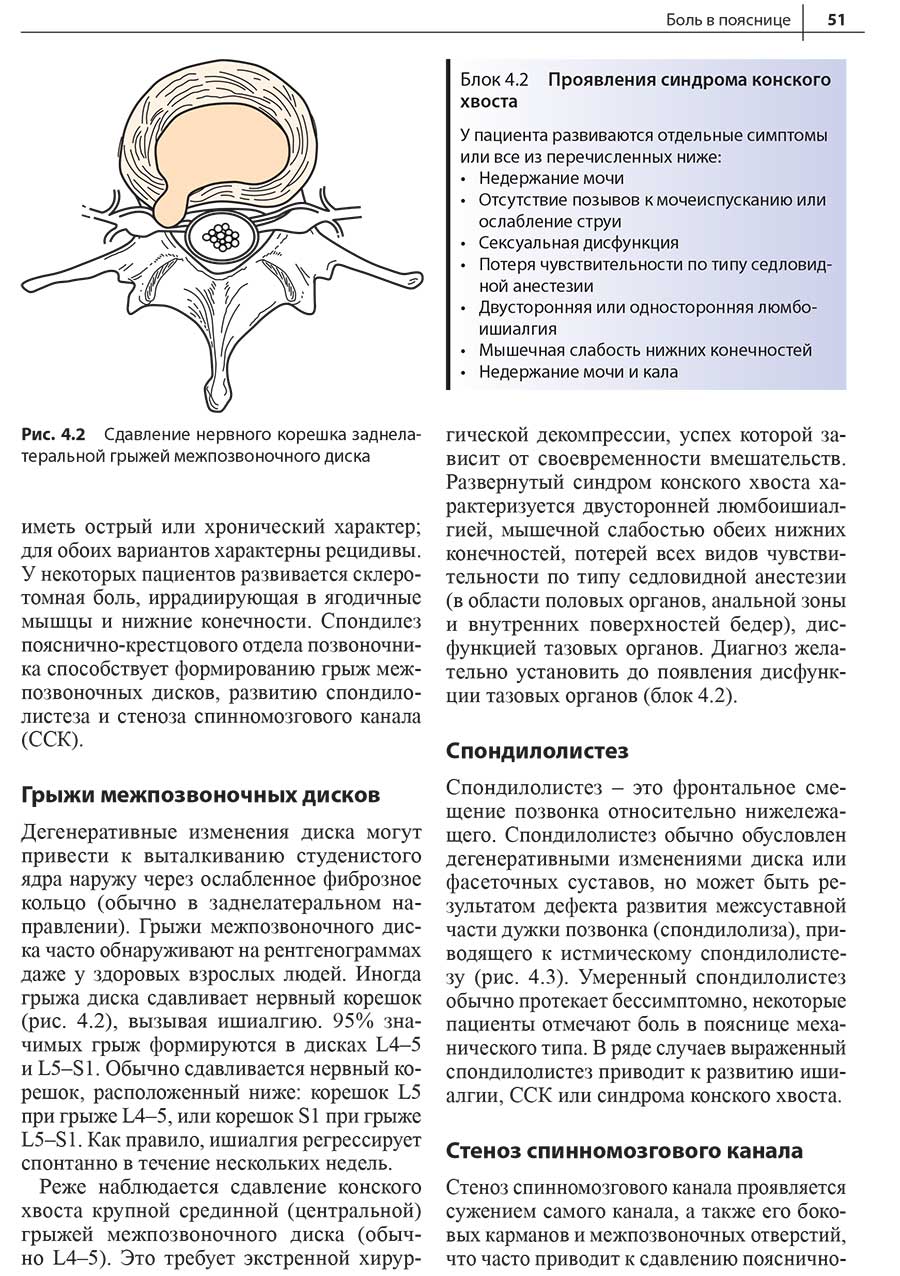 Рис. 4.2 Сдавление нервного корешка заднелатеральной грыжей межпозвоночного диска